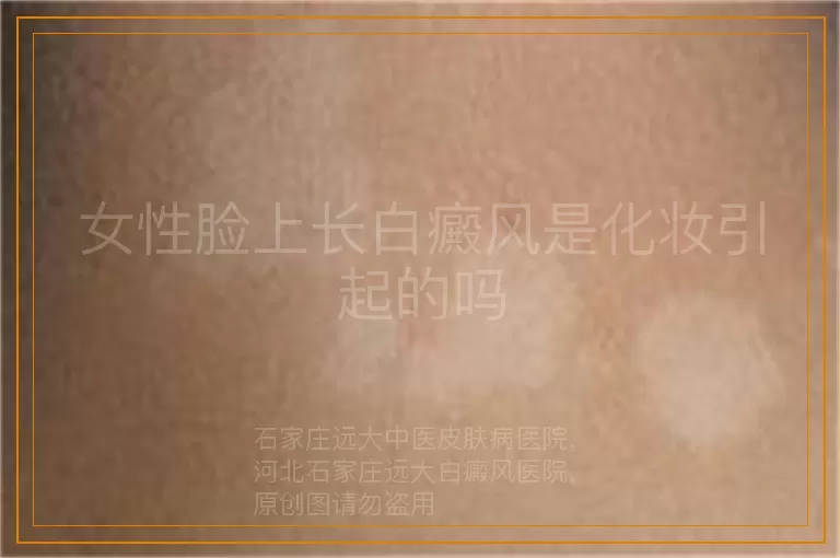女性脸上长白癜风是化妆引起的吗