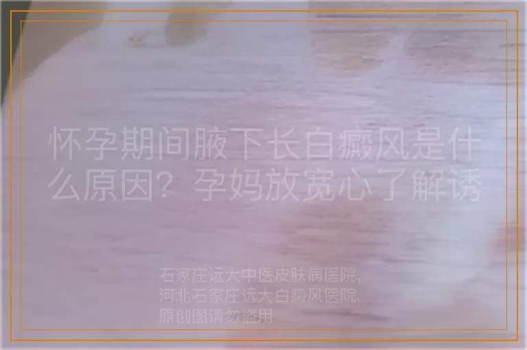 怀孕期间腋下长白癜风是什么原因？孕妈放宽心了解诱因