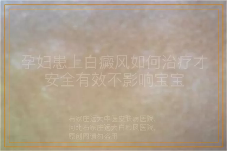 孕妇患上白癜风如何治疗才安全有效不影响宝宝