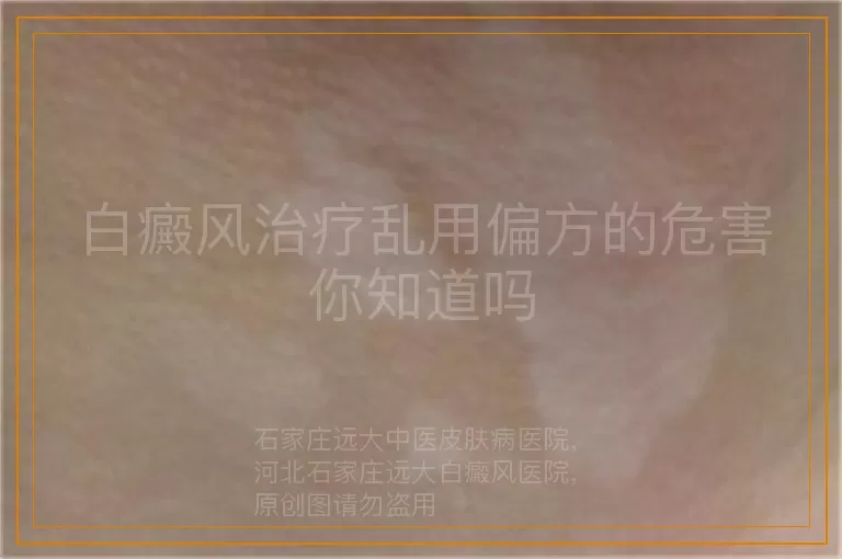 白癜风治疗乱用偏方的危害你知道吗