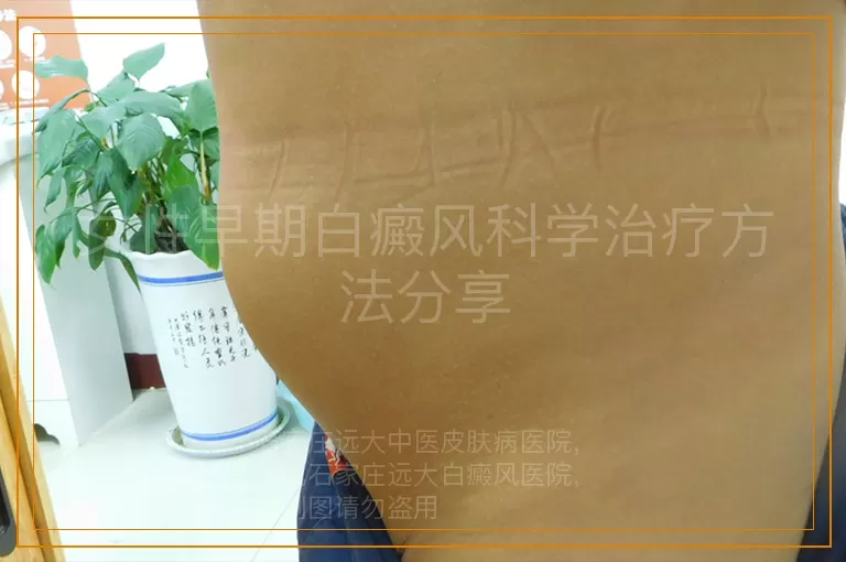 女性早期白癜风科学治疗方法分享