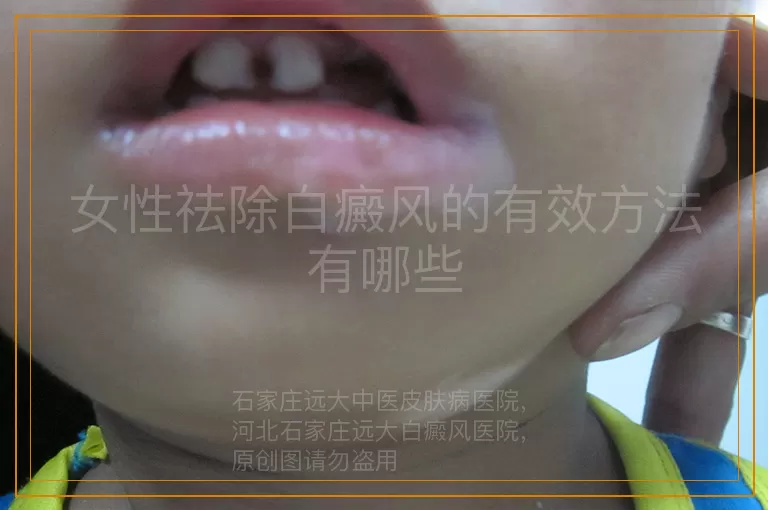女性祛除白癜风的有效方法有哪些