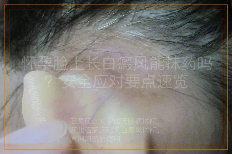 怀孕脸上长白癜风能抹药吗？安全应对要点速览