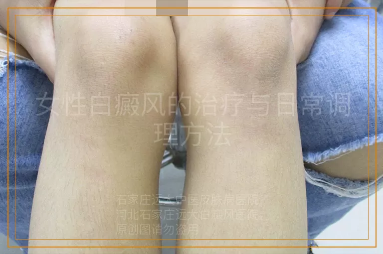 女性白癜风的治疗与日常调理方法