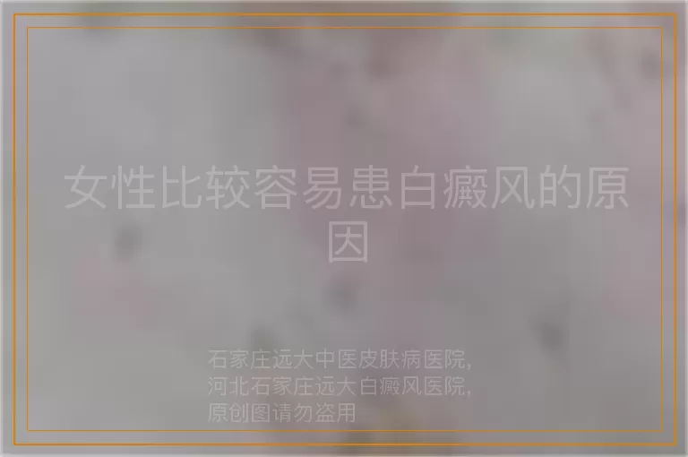 女性比较容易患白癜风的原因