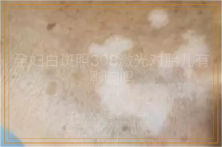 孕妇白斑照308激光对胎儿有影响吗