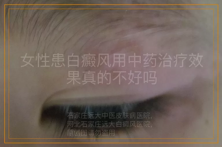 女性患白癜风用中药治疗效果真的不好吗