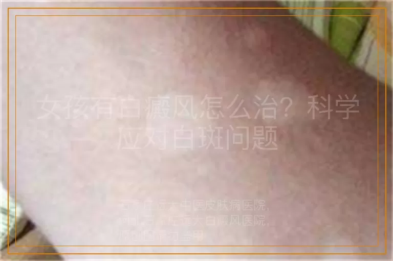 女孩有白癜风怎么治？科学应对白斑问题