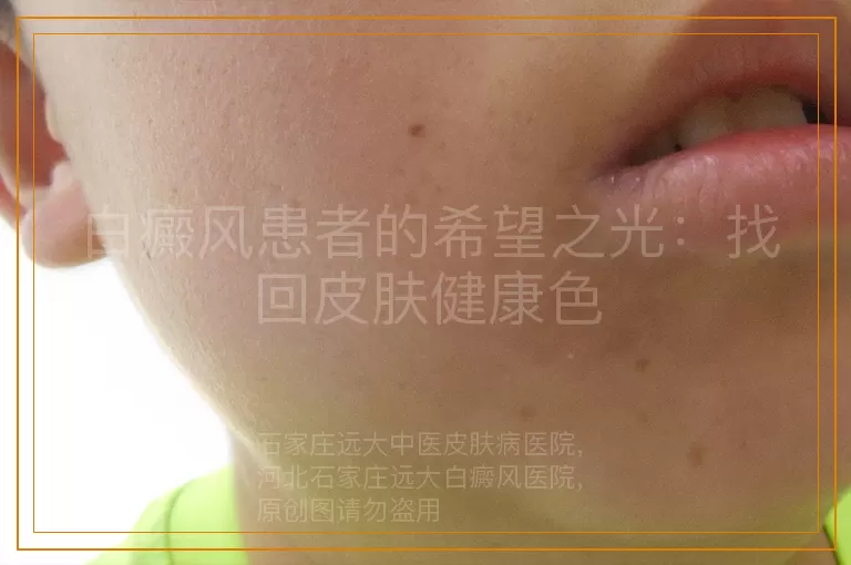 白癜风患者的希望之光：找回皮肤健康色