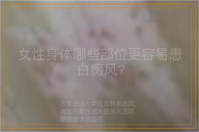 女性身体哪些部位更容易患白癜风?