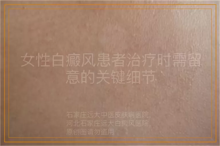 女性白癜风患者治疗时需留意的关键细节
