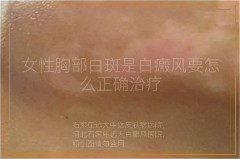 女性胸部白斑是白癜风要怎么正确治疗