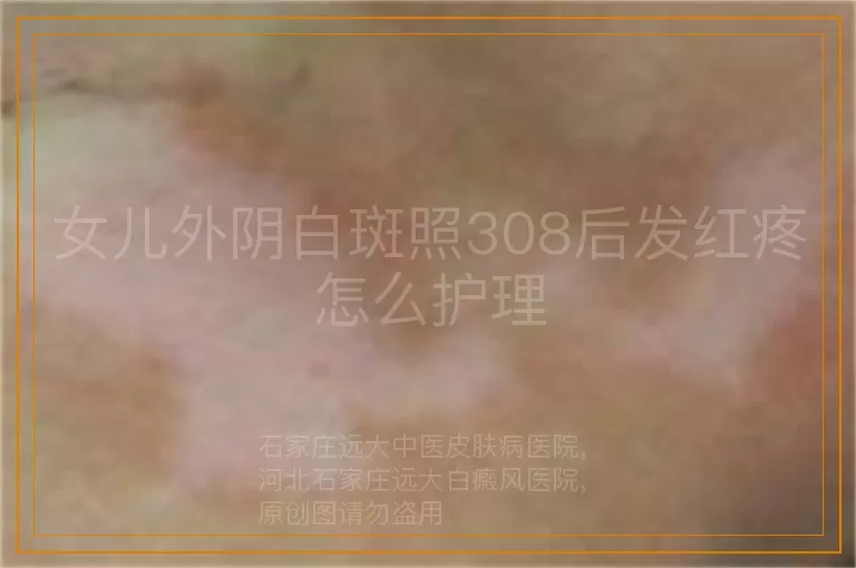 女儿外阴白斑照308后发红疼怎么护理
