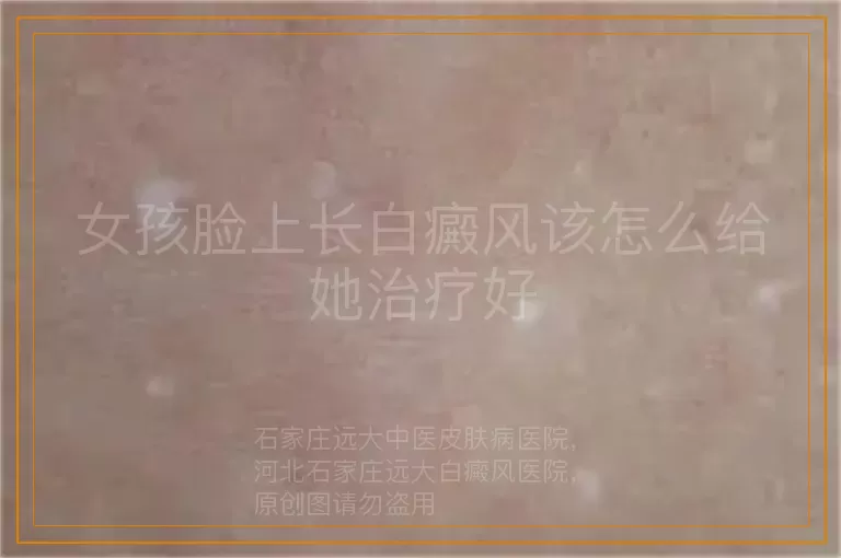 女孩脸上长白癜风该怎么给她治疗好