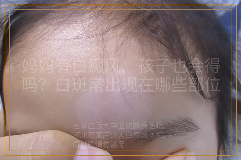 妈妈有白癜风，孩子也会得吗？白斑常出现在哪些部位