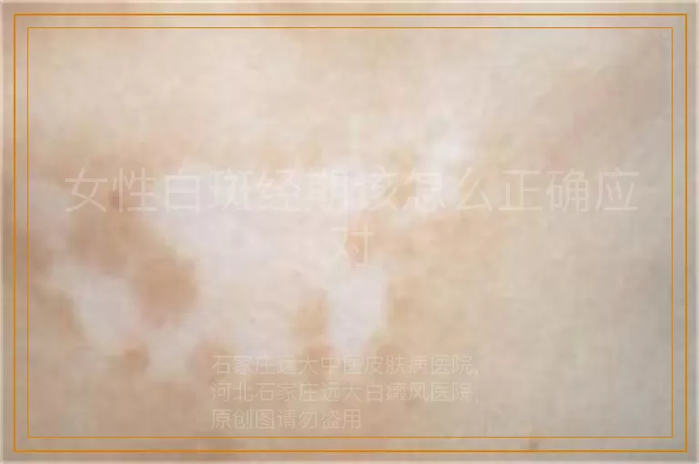 女性白斑经期该怎么正确应对