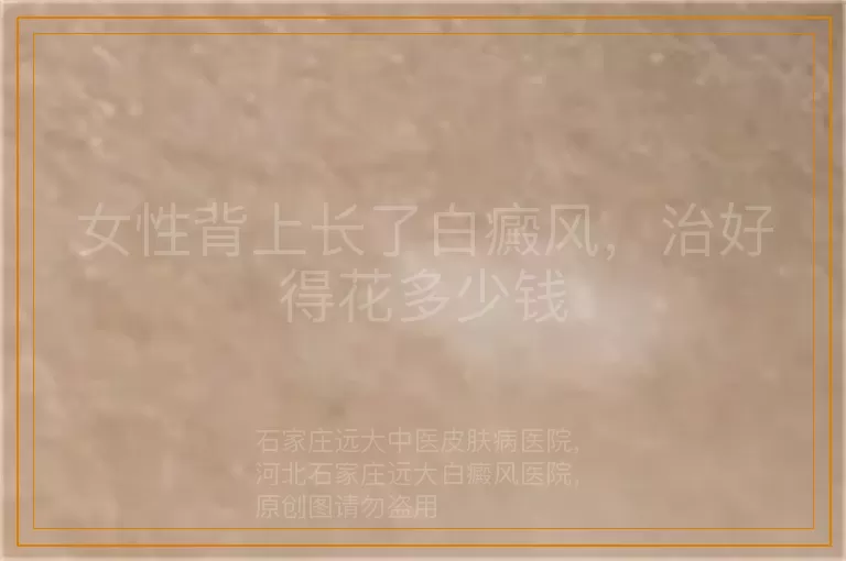 女性背上长了白癜风，治好得花多少钱