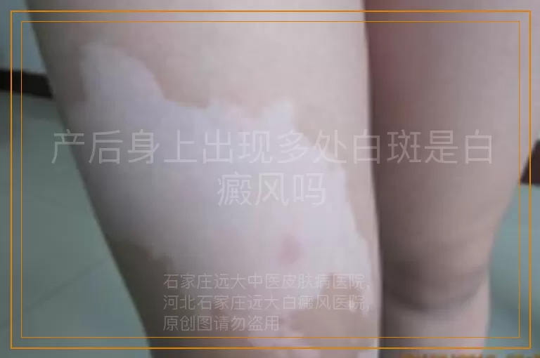 产后身上出现多处白斑是白癜风吗