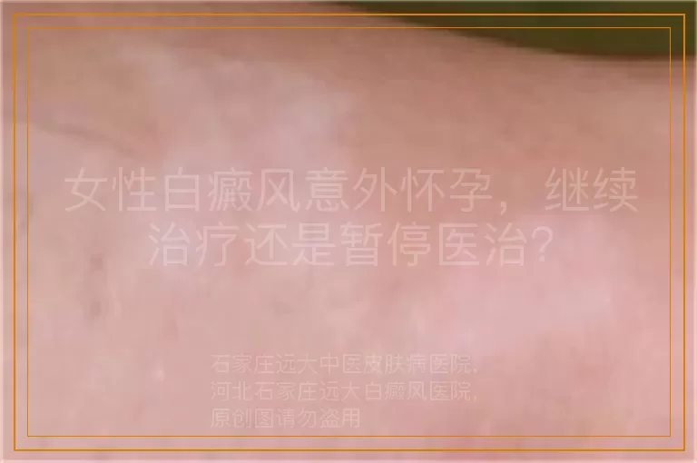 女性白癜风意外怀孕，继续治疗还是暂停医治？