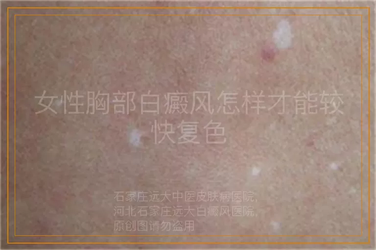 女性胸部白癜风怎样才能较快复色