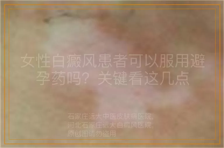 女性白癜风患者可以服用避孕药吗？关键看这几点