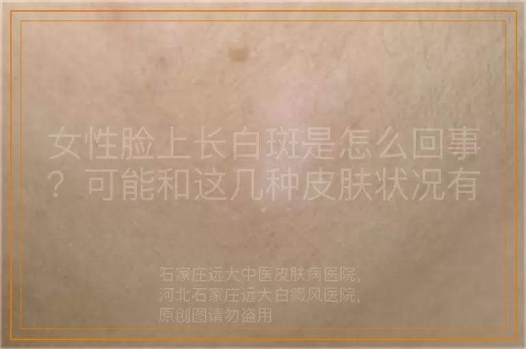 女性脸上长白斑是怎么回事？可能和这几种皮肤状况有关