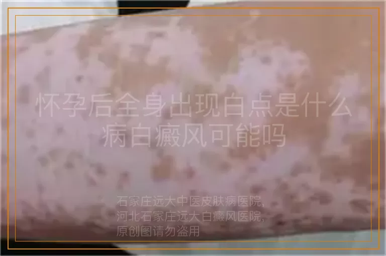 怀孕后全身出现白点是什么病白癜风可能吗