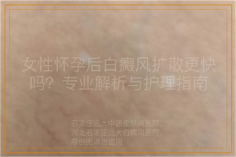 女性怀孕后白癜风扩散更快吗？专业解析与护理指南