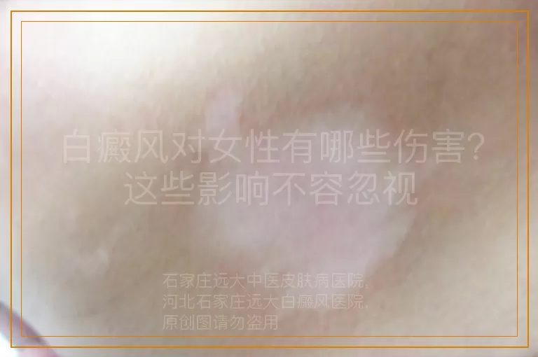 白癜风对女性有哪些伤害？这些影响不容忽视