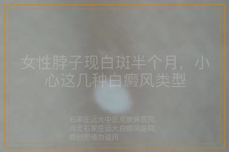 女性脖子现白斑半个月，小心这几种白癜风类型