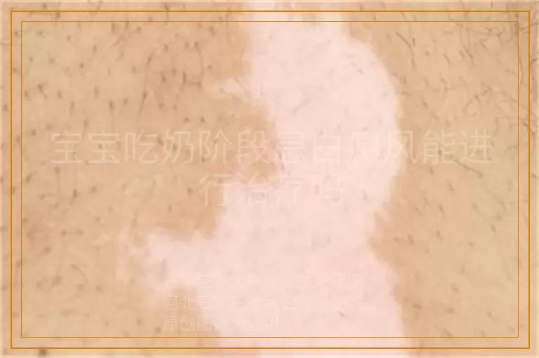 宝宝吃奶阶段患白癜风能进行治疗吗