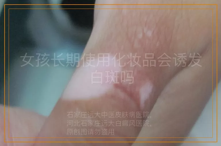 女孩长期使用化妆品会诱发白斑吗