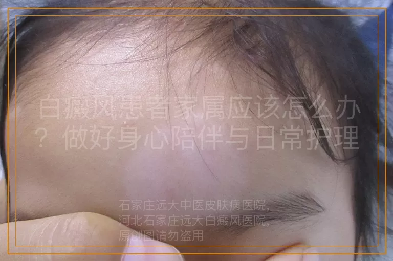 白癜风患者家属应该怎么办？做好身心陪伴与日常护理