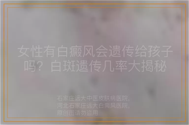 女性有白癜风会遗传给孩子吗？白斑遗传几率大揭秘