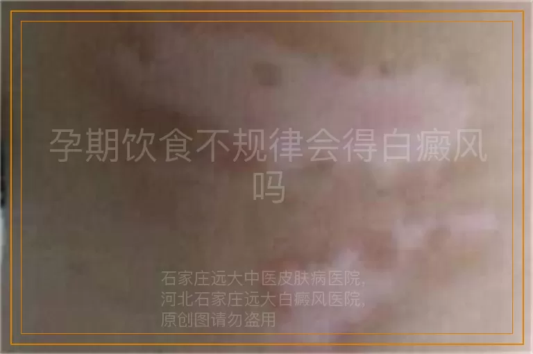 孕期饮食不规律会得白癜风吗