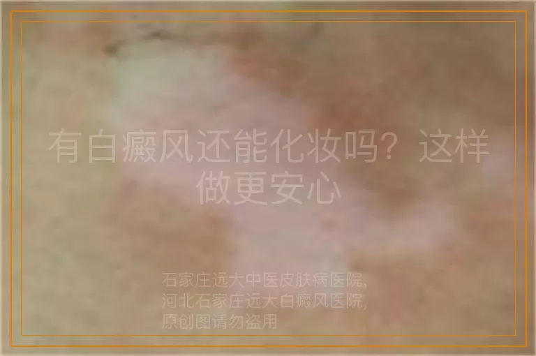 有白癜风还能化妆吗？这样做更安心