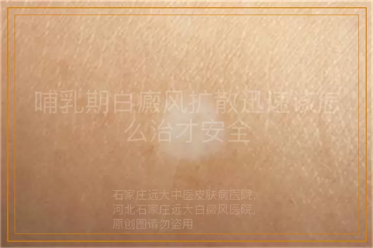 哺乳期白癜风扩散迅速该怎么治才安全