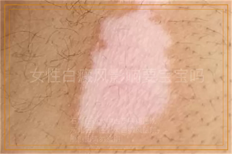 女性白癜风影响要宝宝吗