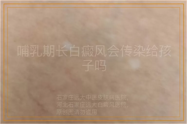 哺乳期长白癜风会传染给孩子吗