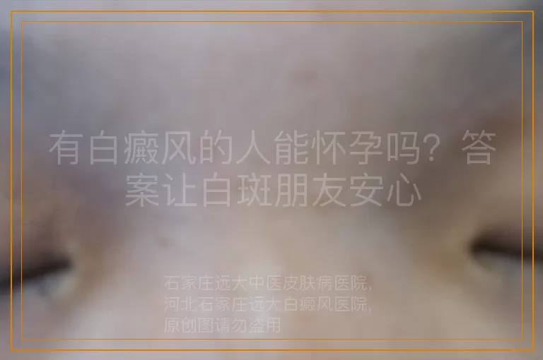 有白癜风的人能怀孕吗？答案让白斑朋友安心