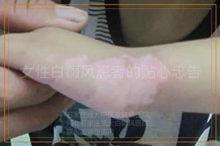 女性白癜风患者的贴心忠告