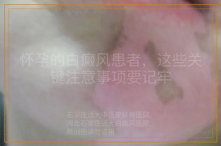 怀孕的白癜风患者，这些关键注意事项要记牢