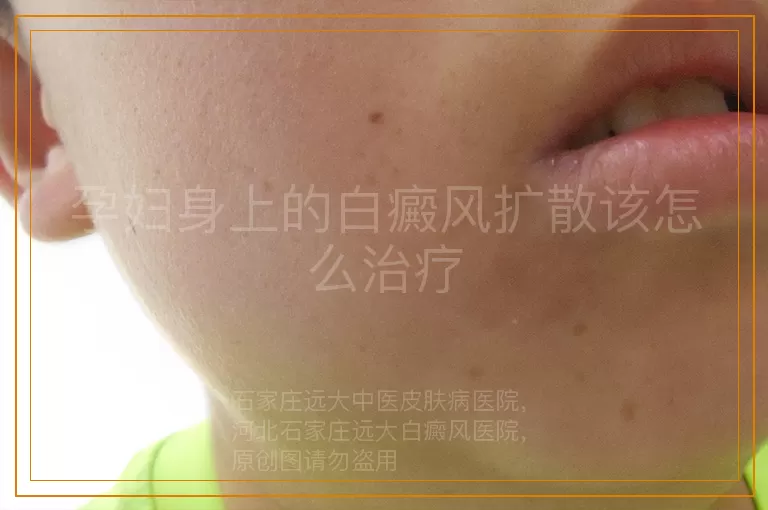 孕妇身上的白癜风扩散该怎么治疗
