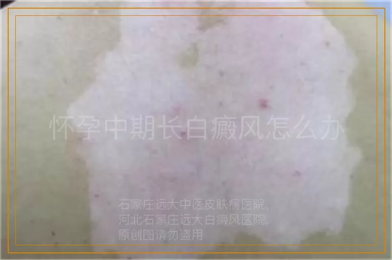 怀孕中期长白癜风怎么办