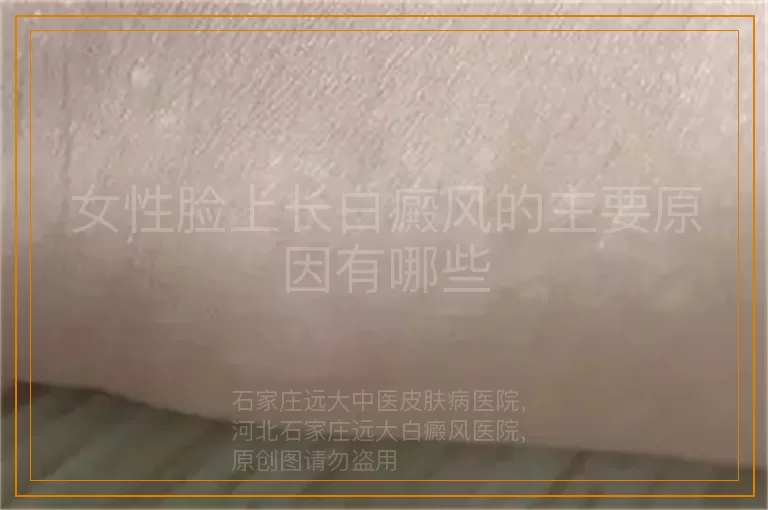 女性脸上长白癜风的主要原因有哪些