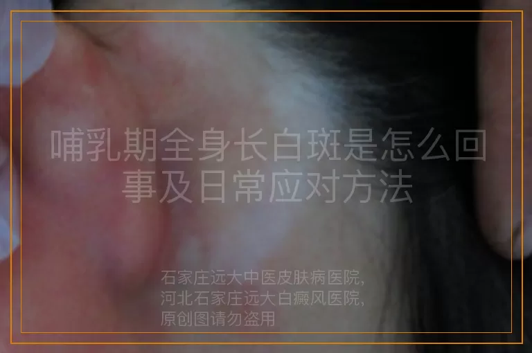 哺乳期全身长白斑是怎么回事及日常应对方法