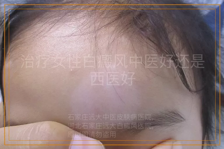 治疗女性白癜风中医好还是西医好