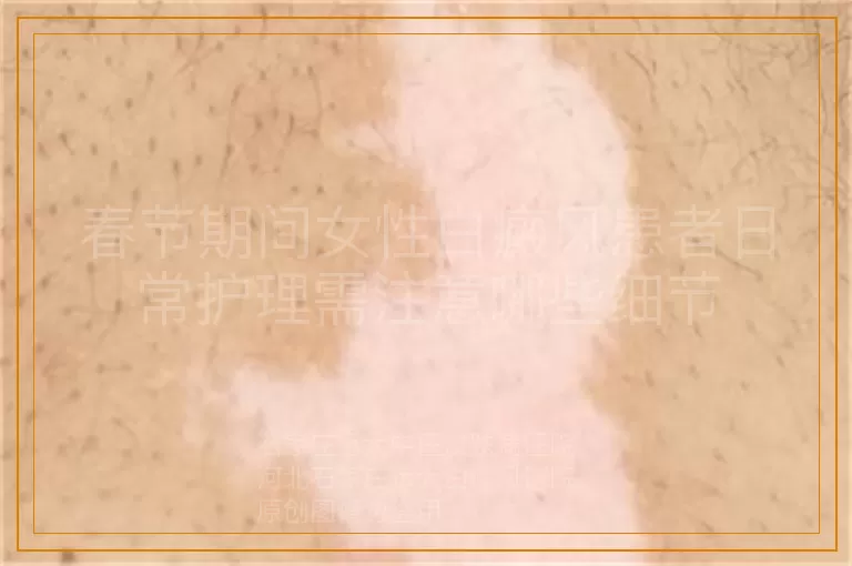 春节期间女性白癜风患者日常护理需注意哪些细节