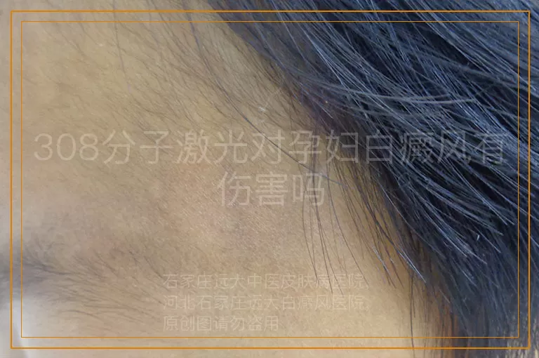 308分子激光对孕妇白癜风有伤害吗