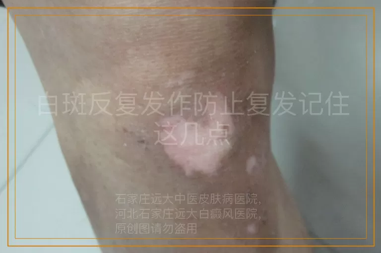 白斑反复发作防止复发记住这几点